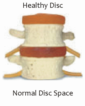 Spinal Decompression Toronto - Disc Degeneration
